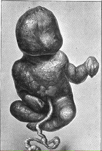 Lithopedion
